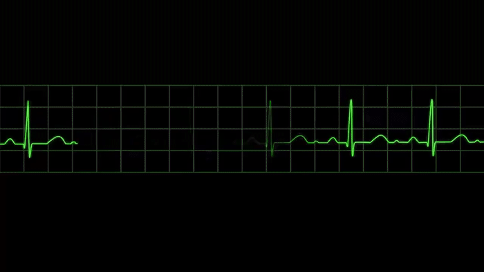Electrocardiograma registra la señal eléctrica del corazón