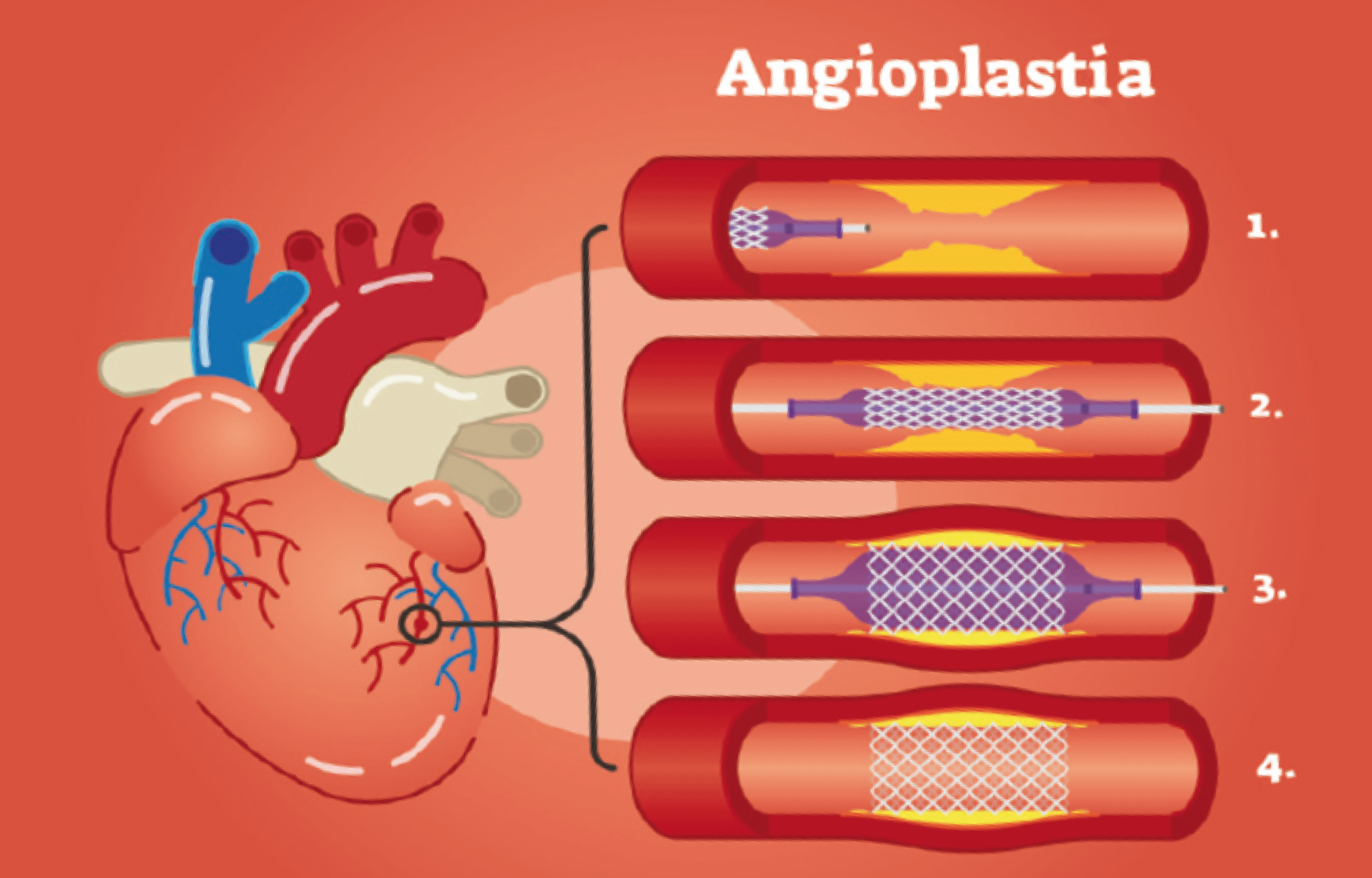 ¿Qué es la angioplastia?