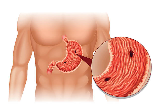 ¿Qué es la úlcera péptica?