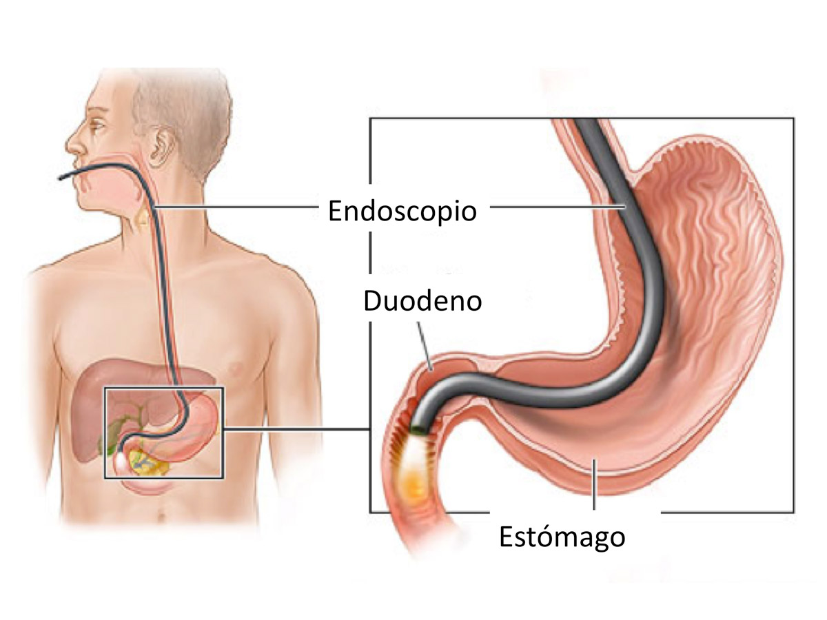 Endoscopia digestiva superior