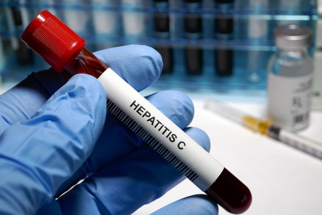 Un Decálogo de Eliminación de la Hepatitis C en el horizonte de 2030