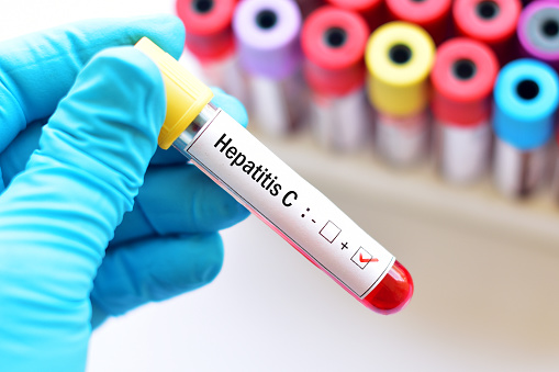 Diagnóstico oportuno de hepatitis C es esencial para evitar cirrosis o cáncer
