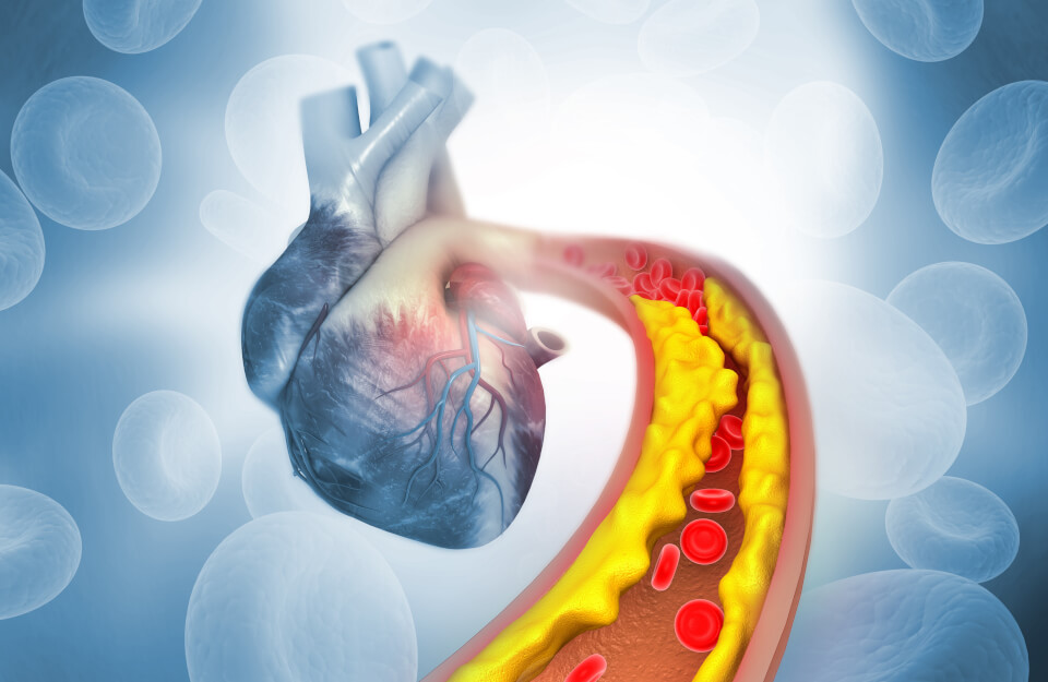 ¿Qué debemos saber sobre colesterol y riesgo vascular?