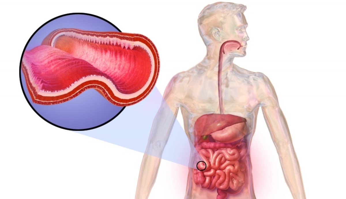 La enfermedad de Crohn: qué es, síntomas y tratamiento