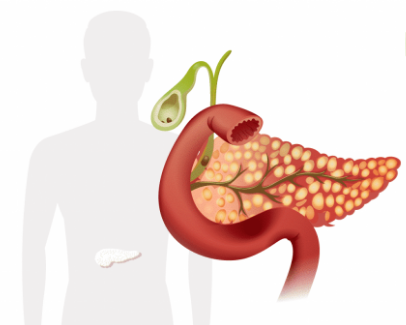 La pancreatitis aguda: una condición inflamatoria del páncreas que requiere atención médica inmediata