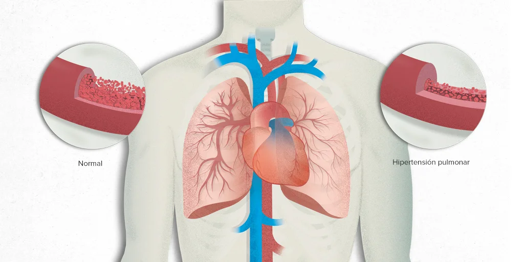 Hipertensión pulmonar