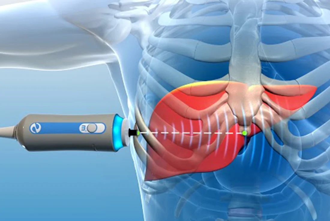 Fibroscan