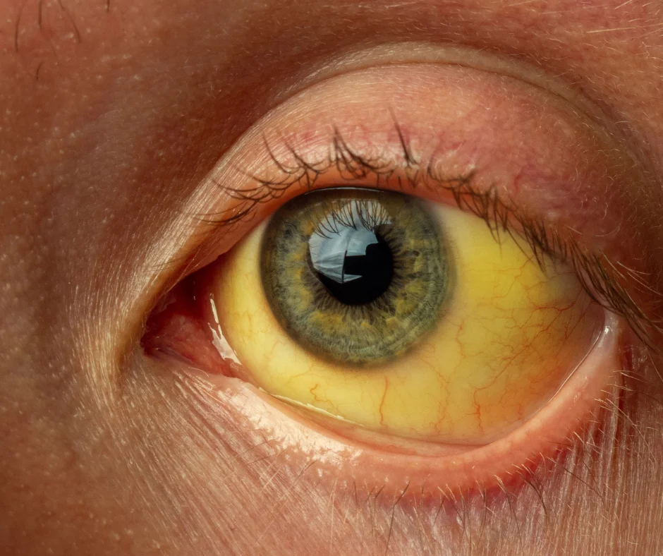 Hepatitis A